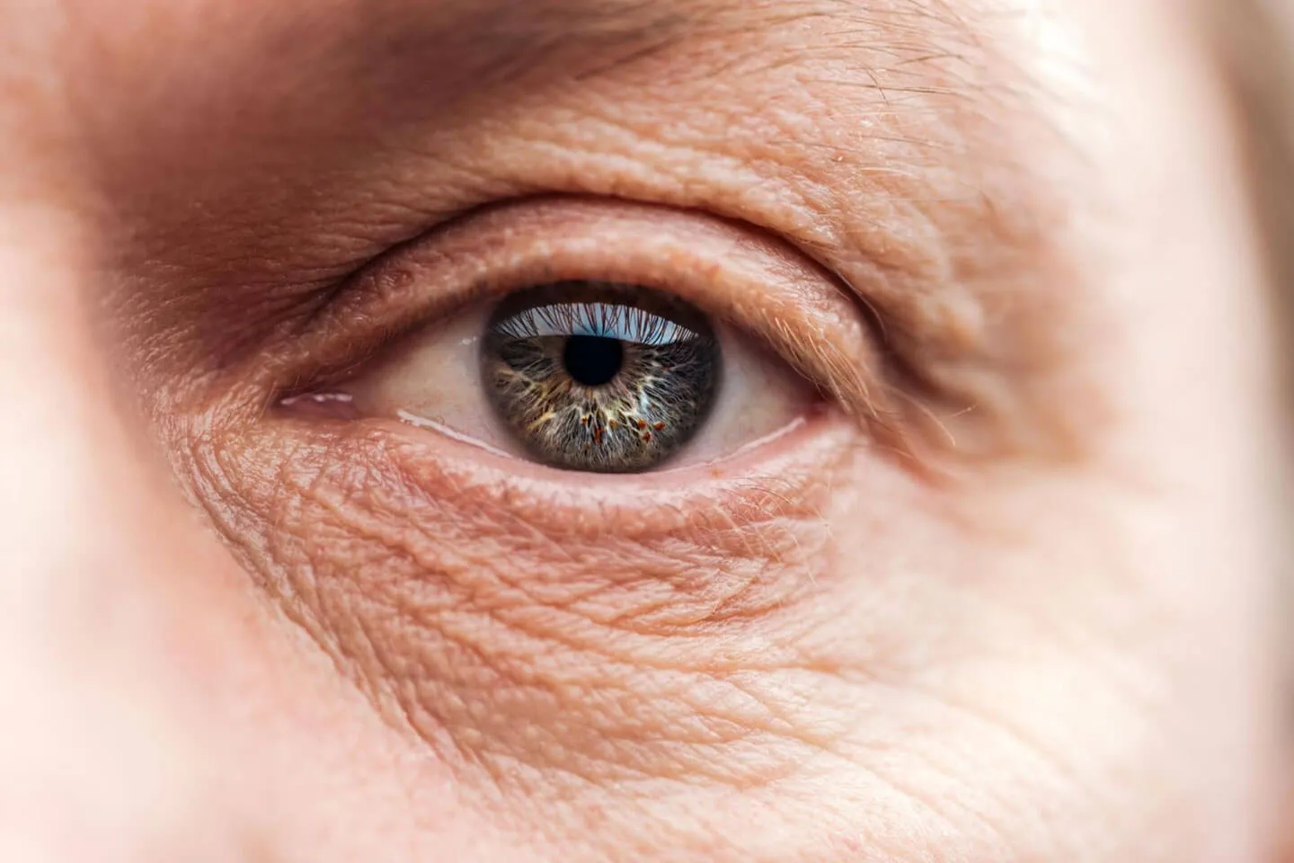 Ojo después de cirugía de párpado realizada por el Dr. Francisco Alain Matabuena. Blefaroplastia en Querétaro y Celaya